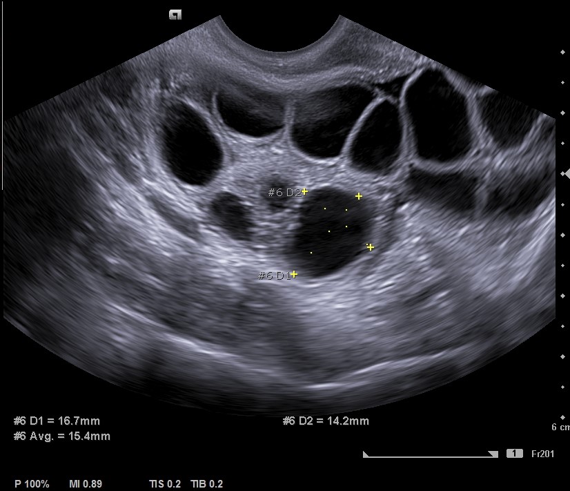 ivf follicle count